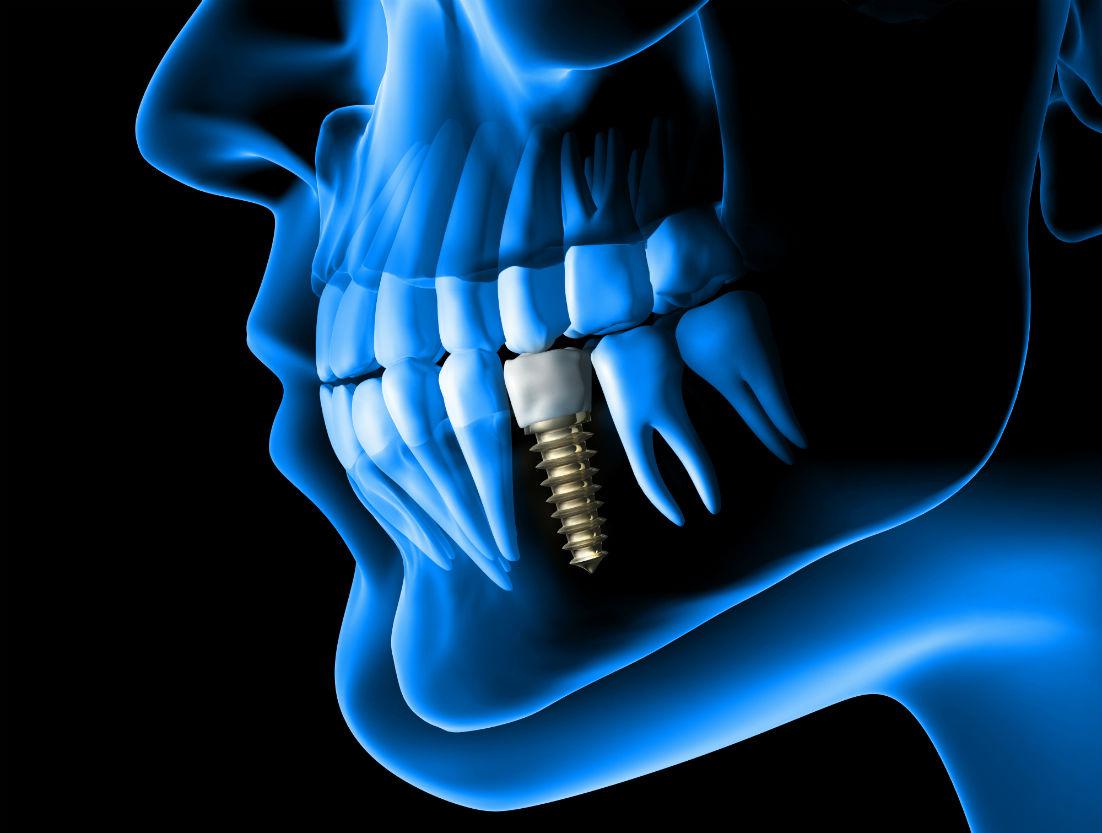 Dental Implants Calabasas & West Los Angeles