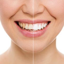 Teeth Whitening in Calabasas and West Los Angeles